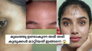 14 days challenge  How to Remove Tiny bumps at home  tiny bumps malayalam  glamyganga [upl. by Celio]