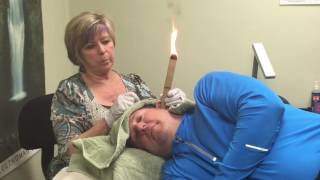 Ear Candling Demonstration Ear Candle at Home Wax Removal Ear Infection Treatment [upl. by Gerard]