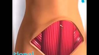 Dr Walid Balti  abdominoplastie  le geste chirurgical [upl. by Halimeda]