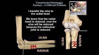 Comminuted Monteggia Fracture Difficult Problem  Everything You Need To Know  Dr Nabil Ebraheim [upl. by Faunie]