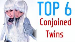 Top Six Conjoined Twin Pairs in History [upl. by Alston]