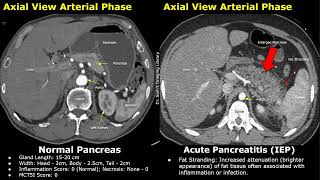 CT Normal Pancreas Vs Acute Pancreatitis  Balthazar Modified CT Severity Index MCTSI Scoring [upl. by Filia873]