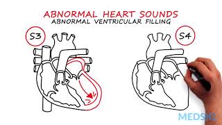 Abnormal Heartsounds and Murmurs Which heart sounds should worry you [upl. by Nyrac]