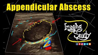 Appendicular Abscess  Ultrasound  Case 332 [upl. by Ardenia657]