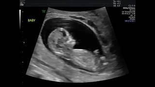 12 WEEK ULTRASOUND MY BABY MOVING amp HEARTBEAT [upl. by Balling745]