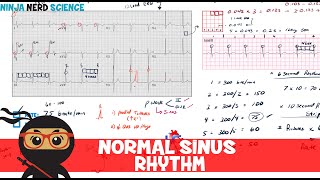 Rate and Rhythm  Normal Sinus Rhythm [upl. by Aelem]