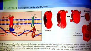 Hereditary SpherocytosisPathology of Hereditary SpherocytosisPathogenesis of HSRobins pathology [upl. by Ariahs]