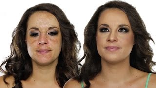 Laser Toning Procedure by Dr Malvika Kohli  Skin Diaries [upl. by Leviram277]