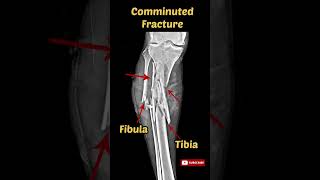 Comminuted Fracture Leg Xray  Trauma fracture xray trauma radiology [upl. by Westmoreland]