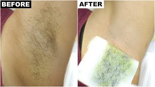 Dark Underarms amp Armpit Hair Removal  BEST amp PERMANENT Solution  Anaysa [upl. by Gass175]