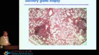 Update on Sjogrens syndrome from pathogeny to treatment  Xavier Mariette MD PhD [upl. by Nylcsoj767]