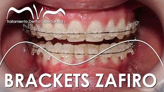 TODO SOBRE LOS BRACKETS ZAFIRO  ¿YA TE DECIDISTE [upl. by Nitsirt]