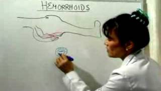 Hemorrhoid Cure What Causes Hemorrhoids [upl. by Orva161]