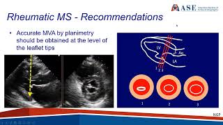 ASE Guideline Recommendations for the Use of Echo in the Evaluation of Rheumatic Heart Disease [upl. by Imelda]