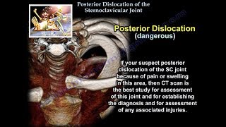 Posterior Dislocation Sternoclavicular Joint  Everything You Need To Know  Dr Nabil Ebraheim [upl. by Yelsa]