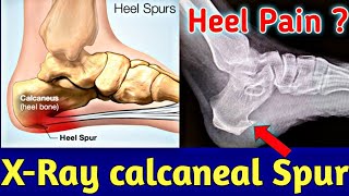 How to read Calcaneal spur or Heel spur in xRay । एड़ी के दर्द का कारण  Uday Xray [upl. by Lew]