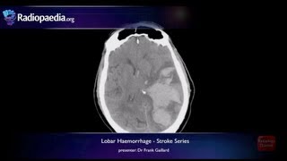 Stroke Lobar haemorrhage  radiology video tutorial MRI CT [upl. by Ttelracs]