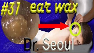 Dr Seoul  Just 4 Minute For Ear Wax Clean 귀지 청소는 단 4분이면 됩니다 Part 31 [upl. by Oz]