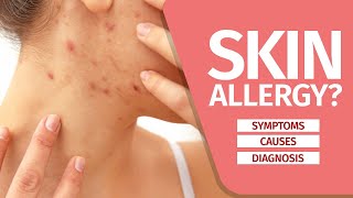 What is Skin Allergy Symptoms Causes Diagnosis and Triggers [upl. by Pessa711]