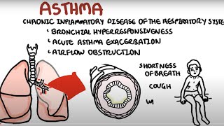 Asthma  Bronchial Asthma  Types  Causes  Pathophysiology  Hindi  Urdu  अस्थमा  Animation [upl. by Eisen870]