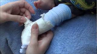 How to remove a fiberglass and plaster cast from an infant [upl. by Nednerb]