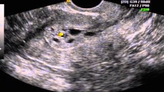 HIPERPLASIA ENDOMETRIAL ADENOMATOSA [upl. by Weigle]