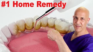 1 Home Remedy to Remove Dental Plaque amp Tarter to Prevent Cavities  Dr Mandell [upl. by Kelam678]