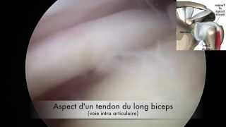 Épaule  Arthroscopie Tendon du long biceps [upl. by Alios]