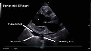 PoCUS Echo  Pericardial vs Pleural Effusions [upl. by Sailesh931]