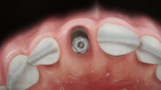 Straumann® BLX  Immediate anterior implant placement [upl. by Bannister]