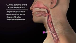 Clinical Benefits of the Passy Muir Valve [upl. by Aratihc]