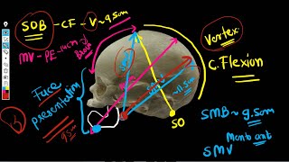 Fetal Skull Diameters  Diameters of engagement [upl. by Malti]