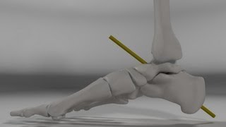 Over Pronation amp Supination Motion Biomechanics of the Subtalar Joint Explained [upl. by Lessur]