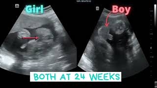 Ultrasound showing Girl Boy both at 24 weeks [upl. by Adnamra]