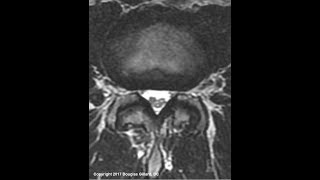 Adhesive Arachnoiditis An Advanced Lecture [upl. by Gurl]