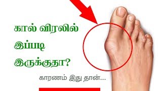 Home Remedies for Rheumatoid Arthritis  Tamil Health Tips [upl. by Langill]