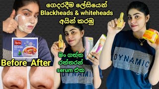 අඩු මුදලකින් ගෙදරදීම White heads amp Black heads අයින් කරගමු 😍  රන්වන් සමක් දෙන 24K Gold Serum 🥰 [upl. by Eetnom]