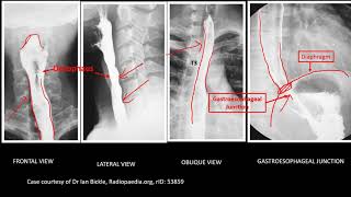 Abdominal XRay Barium swallow Barium Meal and Barium Enema [upl. by Niklaus]