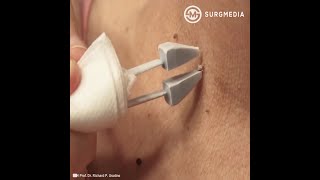 How Does Cryosurgery Cryotherapy  Cryoablation Works medical video shorts [upl. by Ayetal]