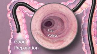 The Importance of Good Bowel Preparation During Colonoscopy [upl. by Nosiram]