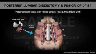 Posterior Lumbar Discectomy amp Fusion of L4S1 [upl. by Ocsecnarf]