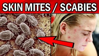 8 Effective Remedies To Get Rid of Skin MitesScabies Naturally [upl. by Anaiuq]