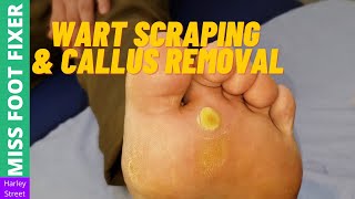 Wart Scraping amp  Bottom Callus Removal   Miss Foot Fixer [upl. by Aymer]