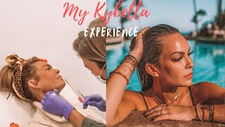 My Kybella experience Before and After 2 kybella treatments [upl. by Nyrehtac]