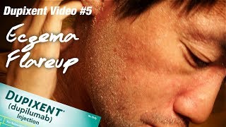 Allergic to DUPIXENT or Topical Steroid Withdrawal TSW Eczema  Ep215 [upl. by Tymothy]