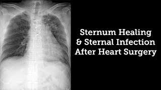 Sternum Healing amp Sternal Infection Rates After Heart Surgery with Dr Steve Bolling [upl. by Fay]