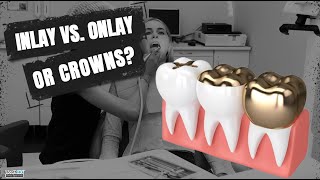 Inlay vs Onlay or Crowns [upl. by Pinelli]