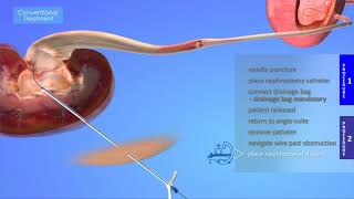 ReSolve ConvertX® Nephroureteral Stent System Introduction [upl. by Kerek]