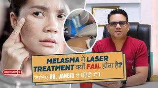 Why Laser Treatment failed in Melasma  Best Treatment for Melasma  Laser Treatment for Melasma [upl. by Nelan292]