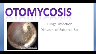 ENT OtoMycosis Fungal Infection Ear [upl. by Deonne]